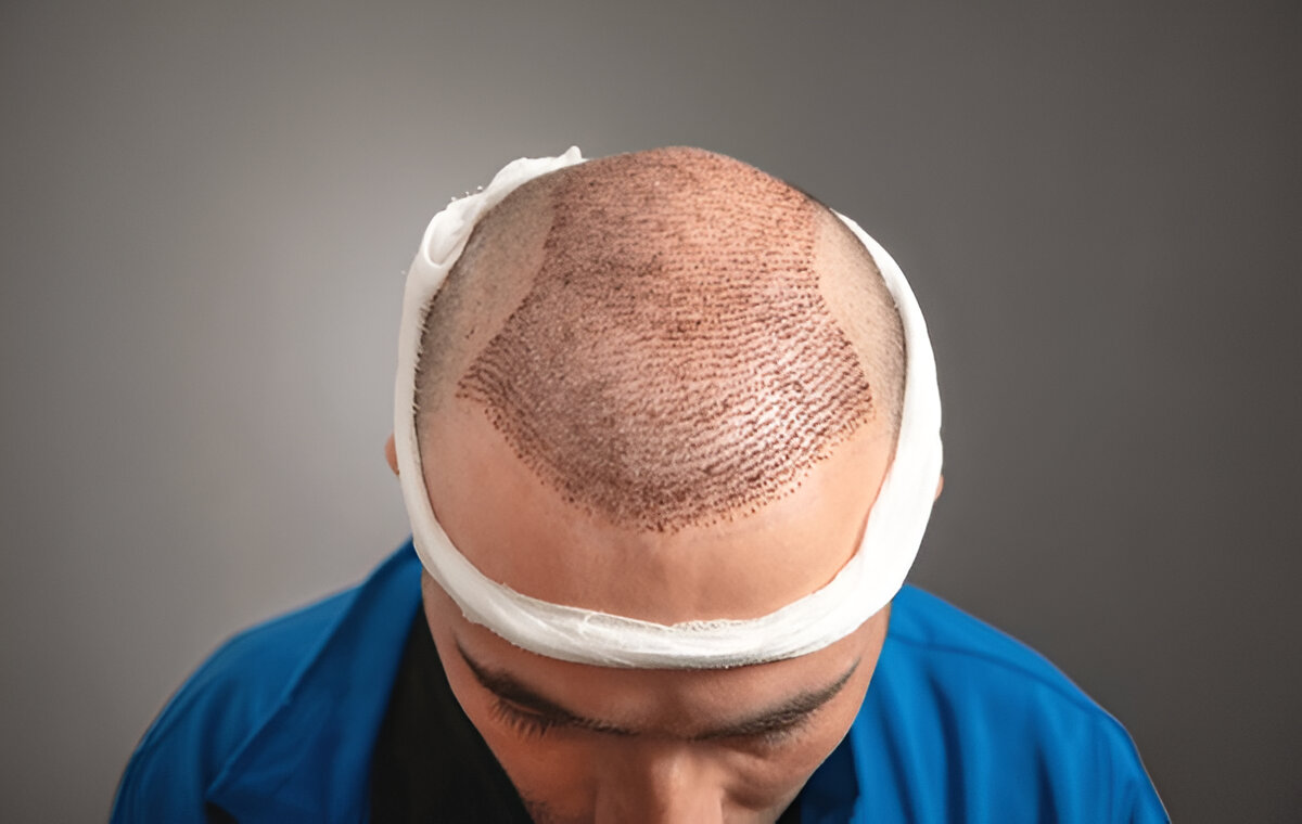 hair transplant UK