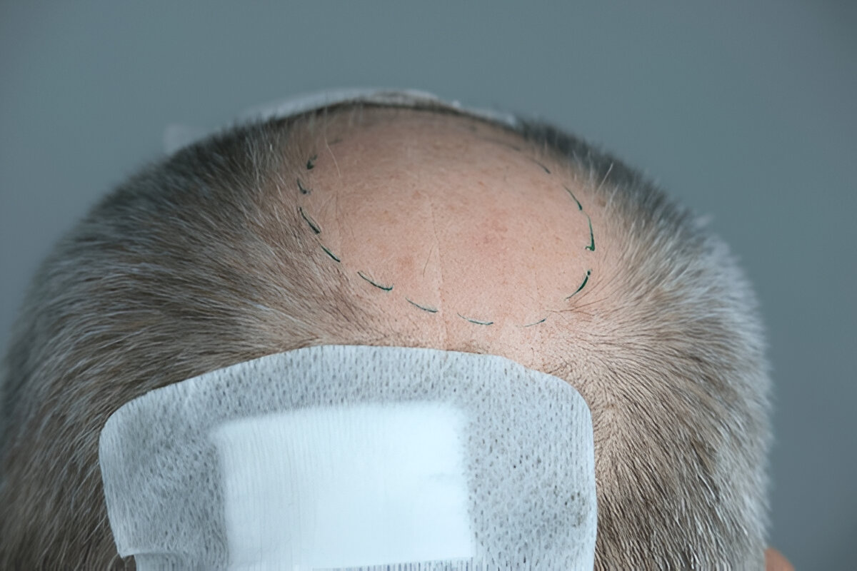 hair transplant