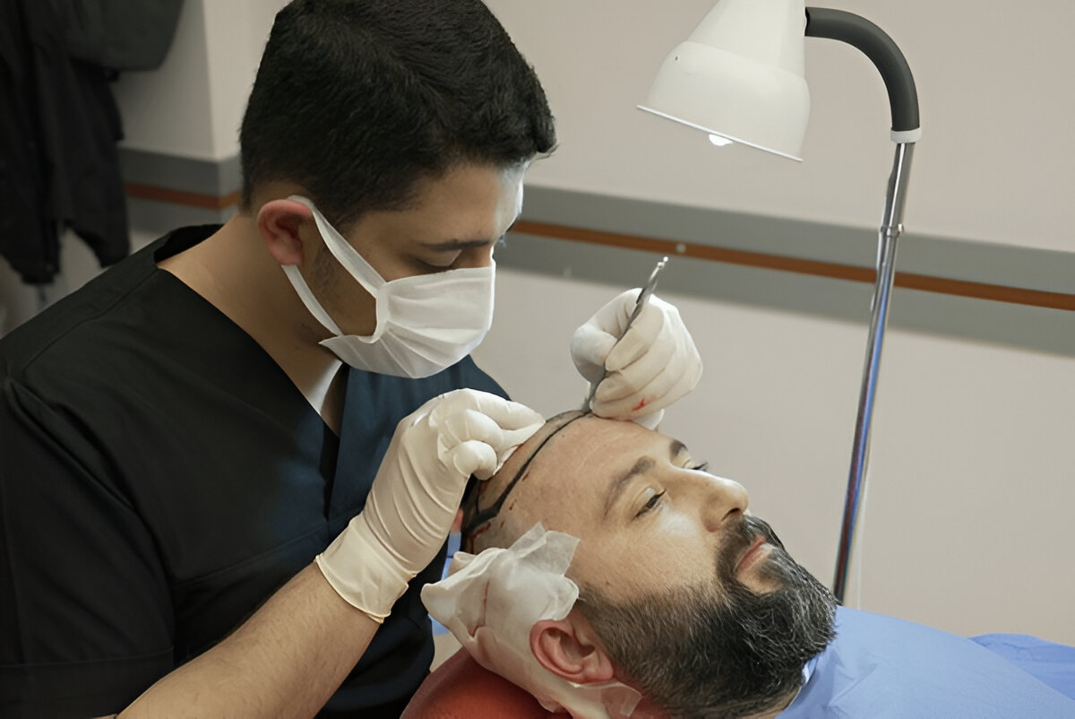 best hair transplant London