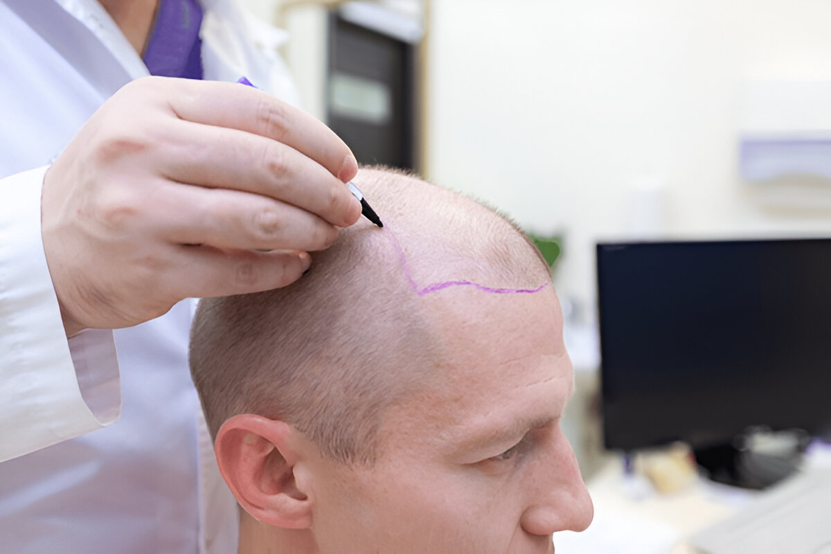 Can You Get a Hair Transplant for Thinning Hair?