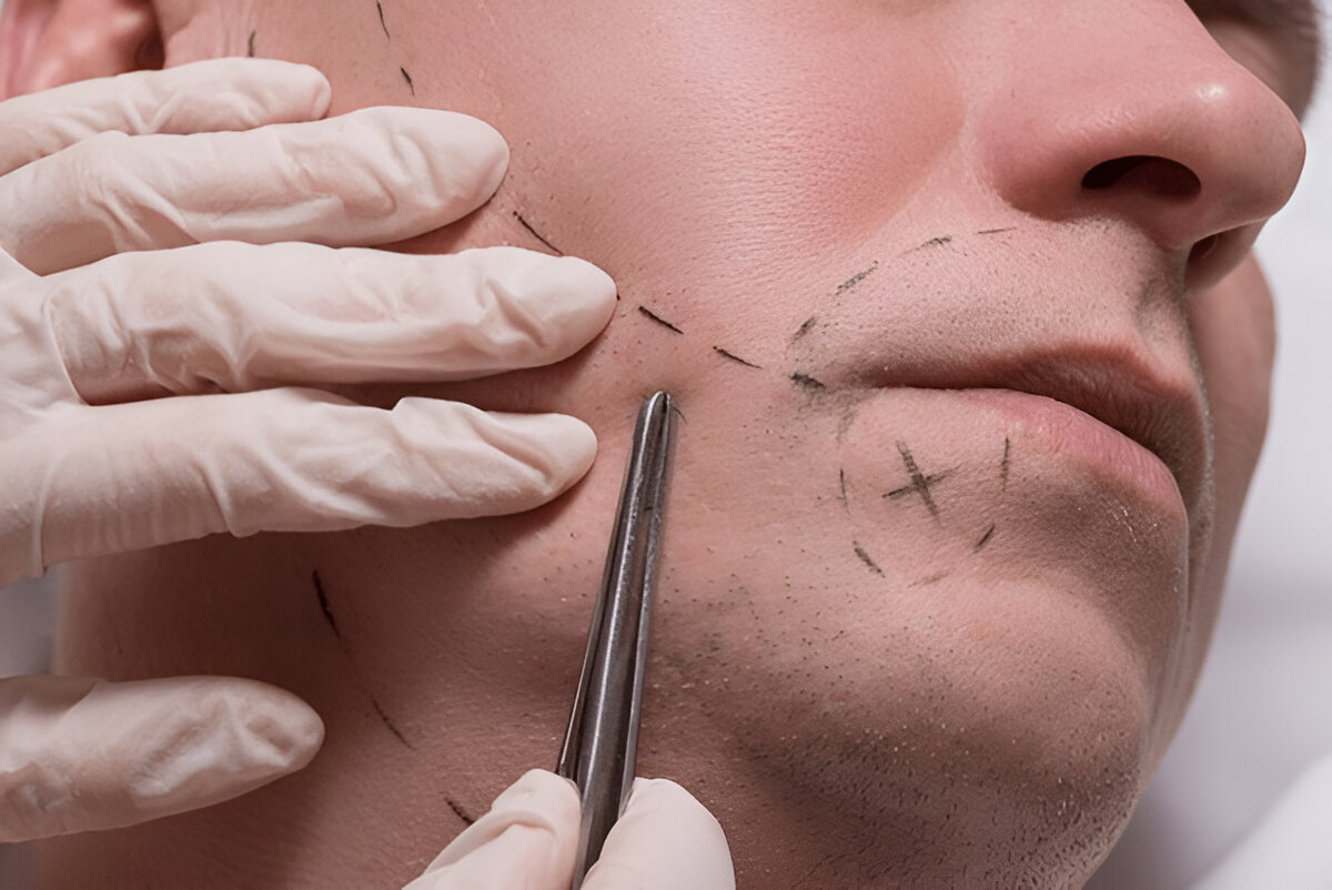 Is Scalp Micropigmentation a Good Alternative to a Hair Transplant