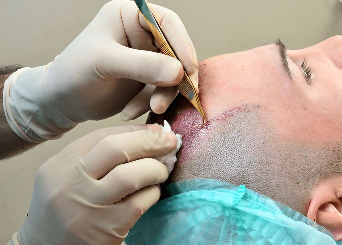Why Some People Experience Hair Transplant Regret