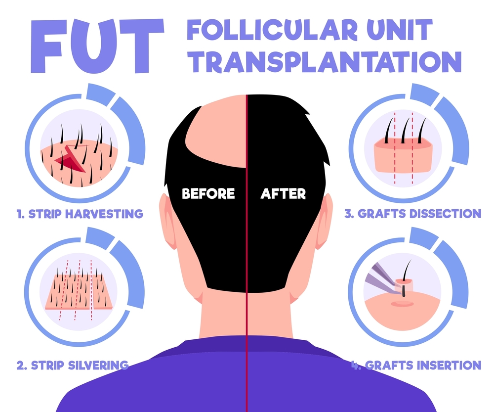 hair transplant London